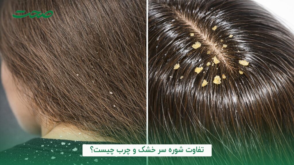 تفاوت شوره سر چرب و خشک چیست؟